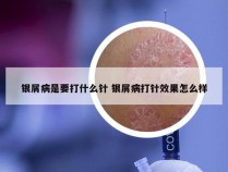 银屑病是要打什么针 银屑病打针效果怎么样