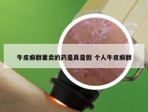 牛皮癣群里卖的药是真是假 个人牛皮癣群