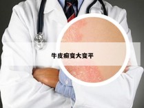 牛皮癣变大变平