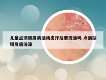 儿童点滴银屑病活动出汗后要洗澡吗 点滴型银屑病洗澡