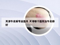 天津牛皮癣专业医院 天津哪个医院治牛皮癖好