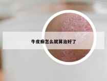 牛皮癣怎么就算治好了
