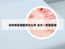 吉林银屑病医院怎么样 吉大一院银屑病