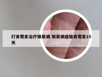 打青霉素治疗银屑病 银屑病连输青霉素15天