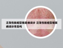 泛发性脓疱型银屑病误诊 泛发性脓疱型银屑病误诊率高吗