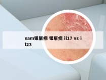 eam银屑病 银屑病 il17 vs il23