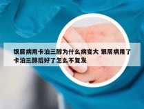 银屑病用卡泊三醇为什么病变大 银屑病用了卡泊三醇后好了怎么不复发