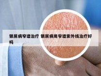 银屑病窄谱治疗 银屑病用窄谱紫外线治疗好吗