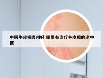中医牛皮癣泉州好 哪里有治疗牛皮癣的老中医