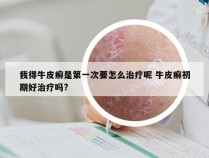 我得牛皮癣是第一次要怎么治疗呢 牛皮癣初期好治疗吗?