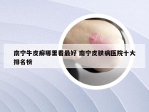 南宁牛皮癣哪里看最好 南宁皮肤病医院十大排名榜