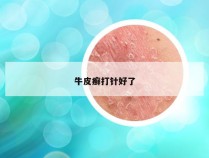 牛皮癣打针好了