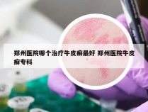 郑州医院哪个治疗牛皮癣最好 郑州医院牛皮癣专科