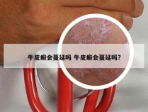牛皮癣会蔓延吗 牛皮癣会蔓延吗?