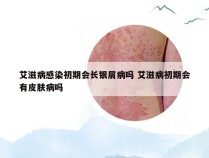 艾滋病感染初期会长银屑病吗 艾滋病初期会有皮肤病吗