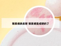 银屑病表皮硬 银屑病变成硬的了