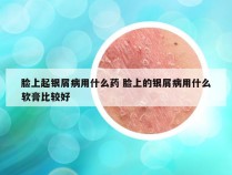 脸上起银屑病用什么药 脸上的银屑病用什么软膏比较好