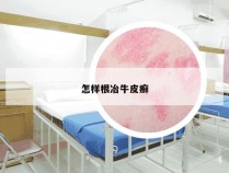 怎样根冶牛皮癣