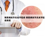 银屑病关节炎关节轻症 银屑病关节炎关节轻症表现
