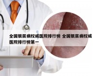 全国银屑病权威医院排行榜 全国银屑病权威医院排行榜第一