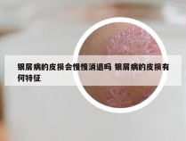 银屑病的皮损会慢慢消退吗 银屑病的皮损有何特征