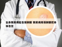 全身银屑病能包保鲜膜 银屑病用保鲜膜把身体包住