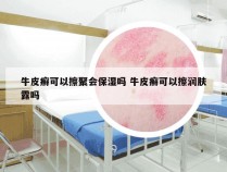 牛皮癣可以擦聚会保湿吗 牛皮癣可以擦润肤露吗