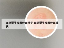 血热型牛皮癣什么样子 血热型牛皮癣什么症状