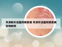 天津新长征医院银屑病 天津长征医院银屑病生物制剂