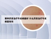 那种药膏治疗牛皮癣最好 什么药膏治疗牛皮癣最有效