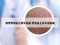 做梦梦到自己得牛皮癣 梦见身上长牛皮肤病