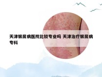 天津银屑病医院比较专业吗 天津治疗银屑病专科