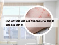 红皮病型银屑病图片属于特殊病 红皮型银屑病和红皮病区别