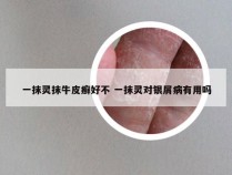 一抹灵抹牛皮癣好不 一抹灵对银屑病有用吗