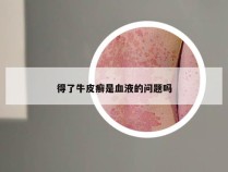 得了牛皮癣是血液的问题吗