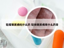 轻度银屑病吃什么药 轻微银屑病用什么药膏