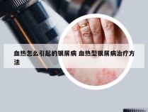 血热怎么引起的银屑病 血热型银屑病治疗方法