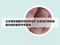 北京银屑病医院及如何治疗 北京治疗银屑病最权威的医院专家是谁