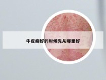 牛皮癣好的时候先从哪里好