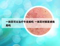 一抹灵可以治疗牛皮癣吗 一抹灵对银屑病有用吗