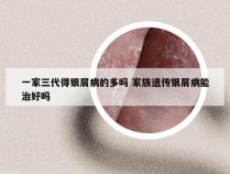 一家三代得银屑病的多吗 家族遗传银屑病能治好吗