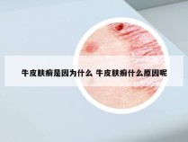 牛皮肤癣是因为什么 牛皮肤癣什么原因呢