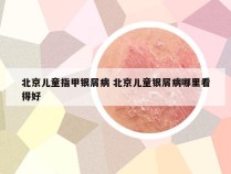 北京儿童指甲银屑病 北京儿童银屑病哪里看得好
