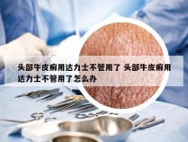 头部牛皮癣用达力士不管用了 头部牛皮癣用达力士不管用了怎么办
