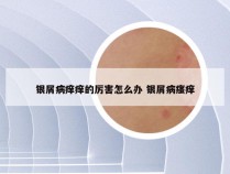 银屑病痒痒的厉害怎么办 银屑病瘙痒
