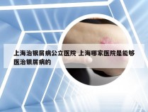 上海治银屑病公立医院 上海哪家医院是能够医治银屑病的