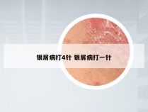 银屑病打4针 银屑病打一针