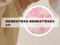 银屑病脱皮严重贫血 银屑病脱皮严重贫血怎么办