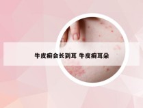 牛皮癣会长到耳 牛皮癣耳朵