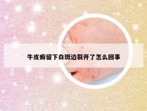 牛皮癣留下白斑边裂开了怎么回事